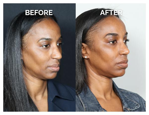 Rhinoplasty Before & After Gallery - Patient 305473 - Image 1