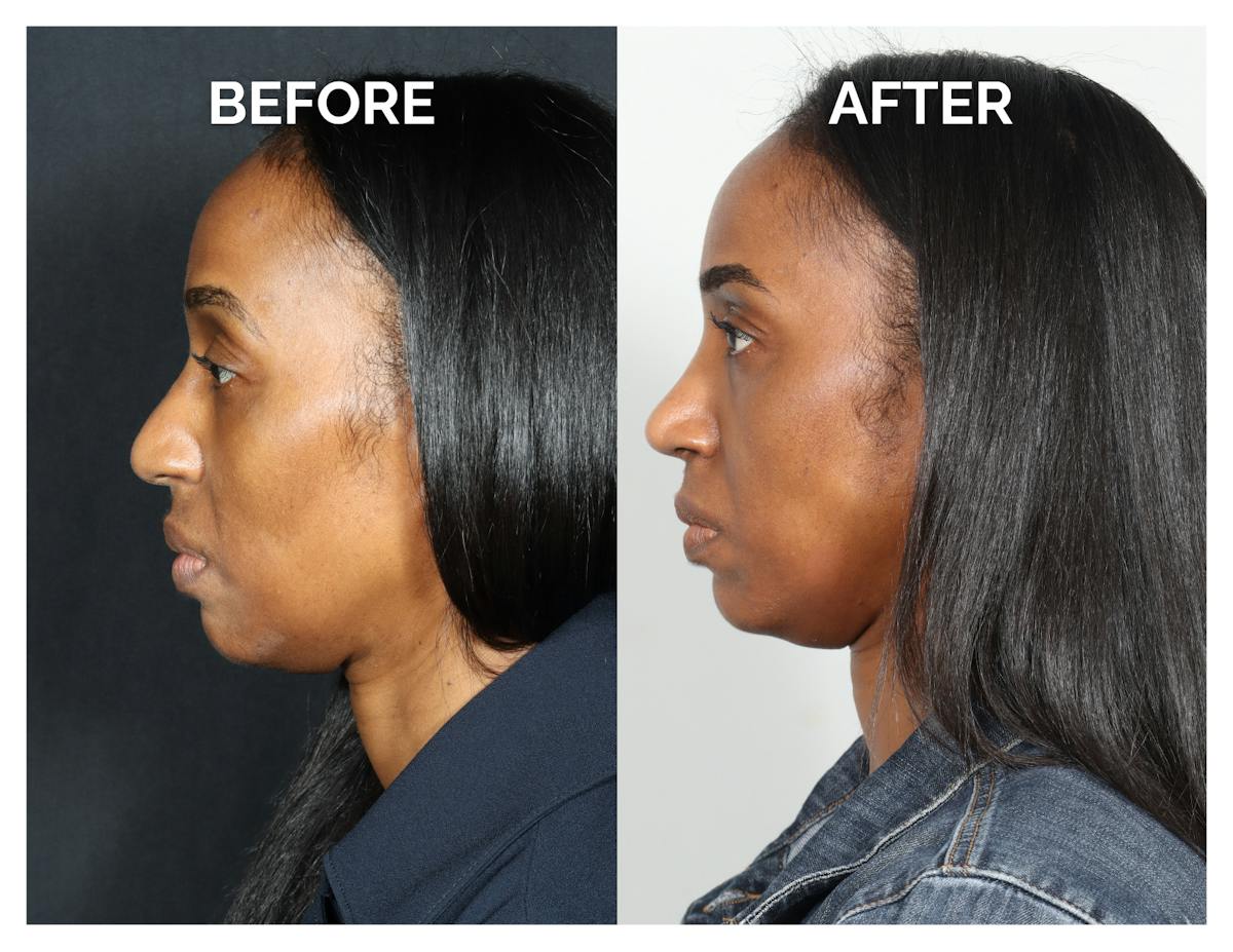 Rhinoplasty Before & After Gallery - Patient 305473 - Image 2