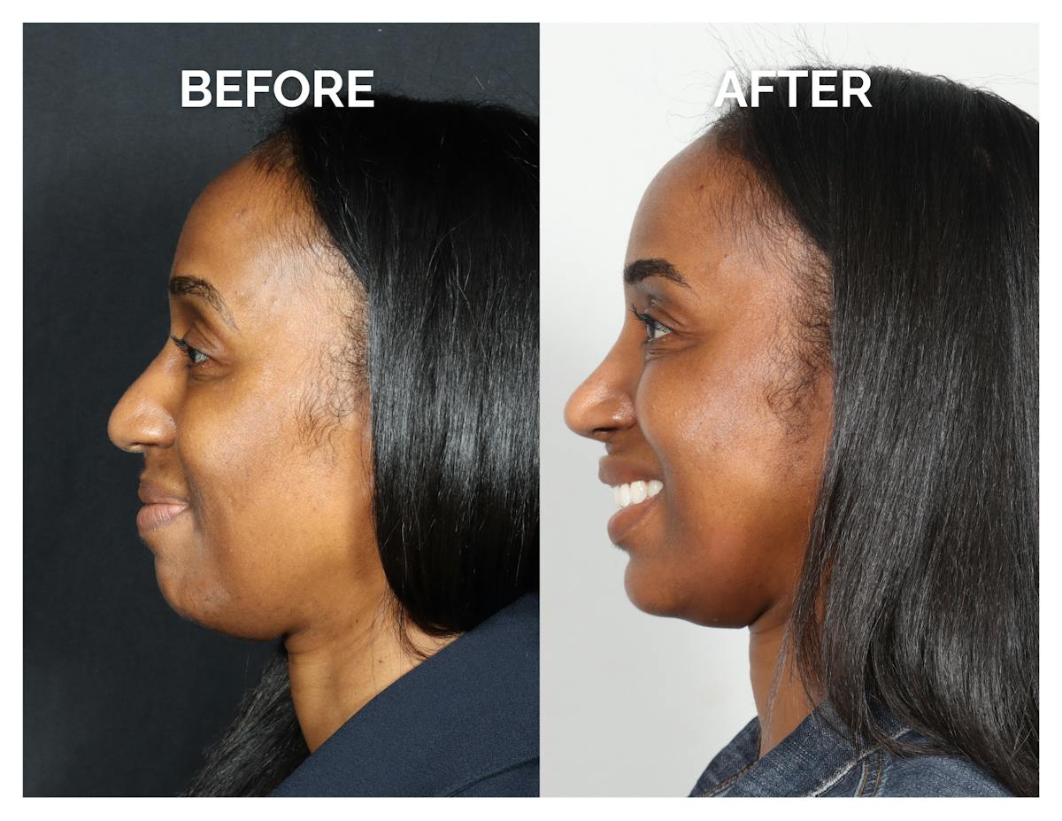 Rhinoplasty Before & After Gallery - Patient 305473 - Image 3