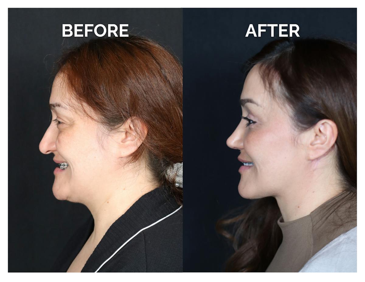 Rhinoplasty Before & After Gallery - Patient 223270 - Image 5