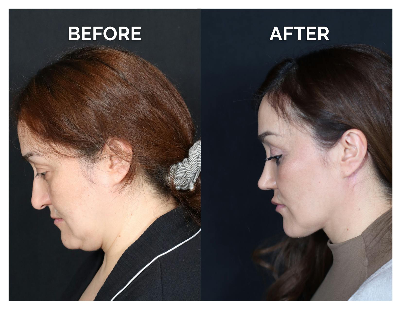 Rhinoplasty Before & After Gallery - Patient 223270 - Image 4