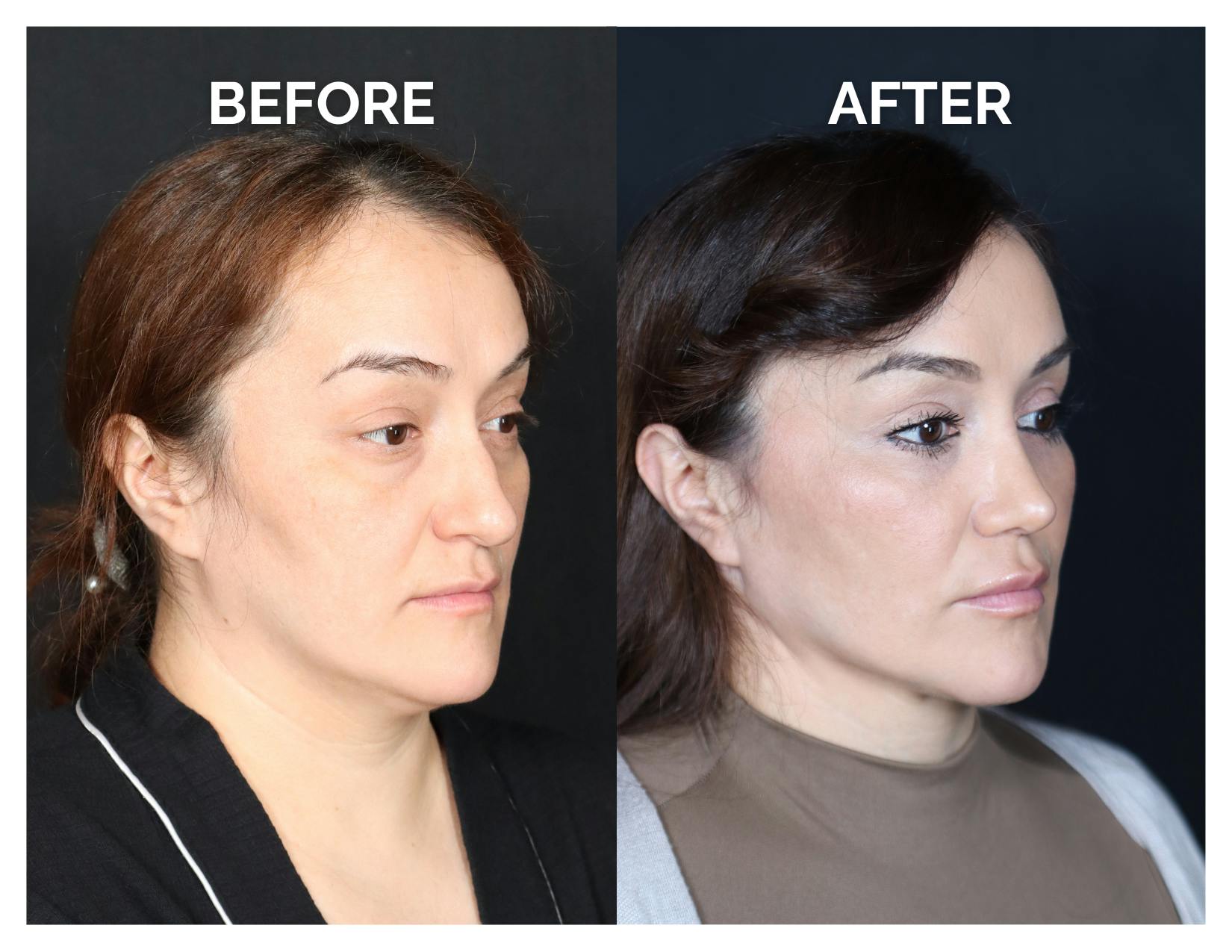 Rhinoplasty Before & After Gallery - Patient 223270 - Image 1