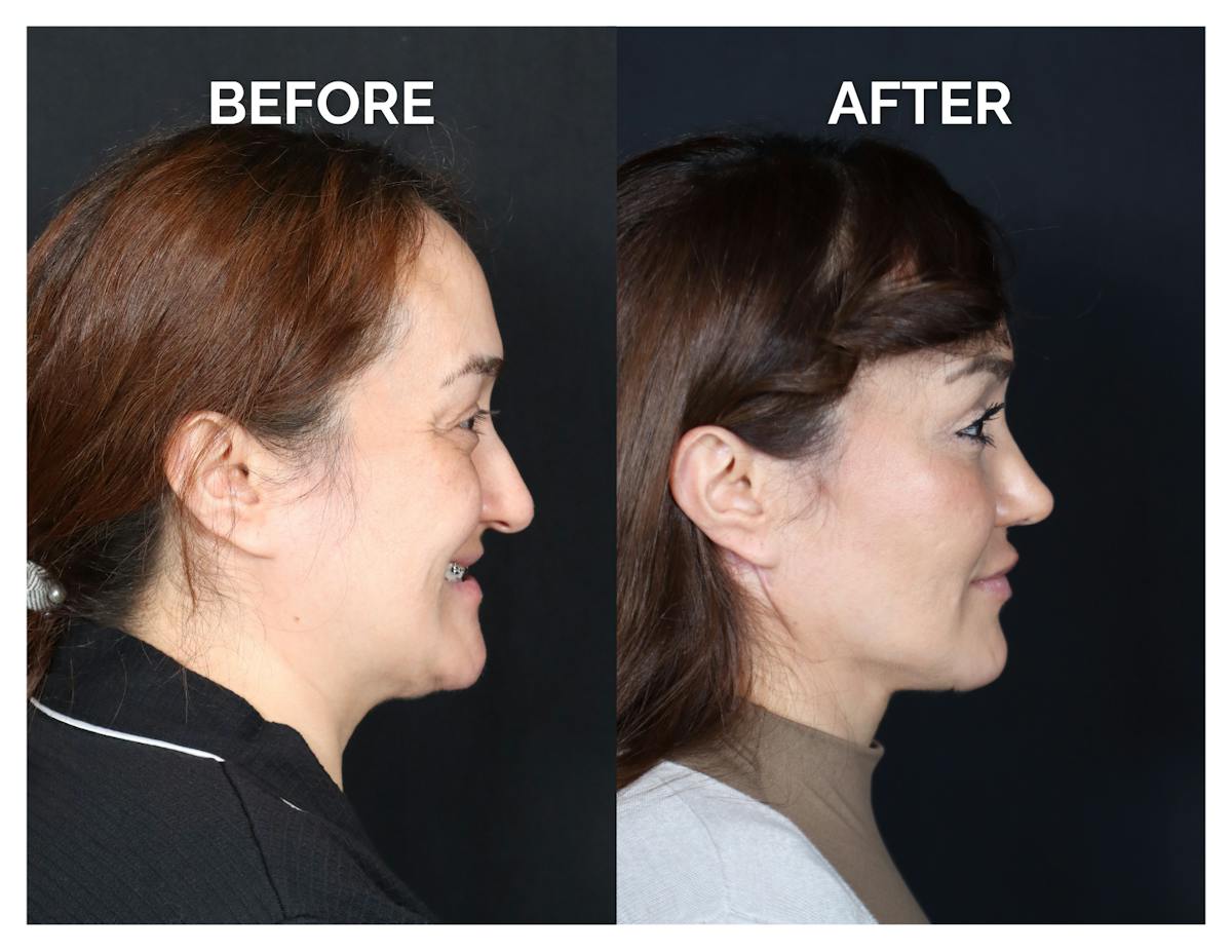 Rhinoplasty Before & After Gallery - Patient 223270 - Image 3