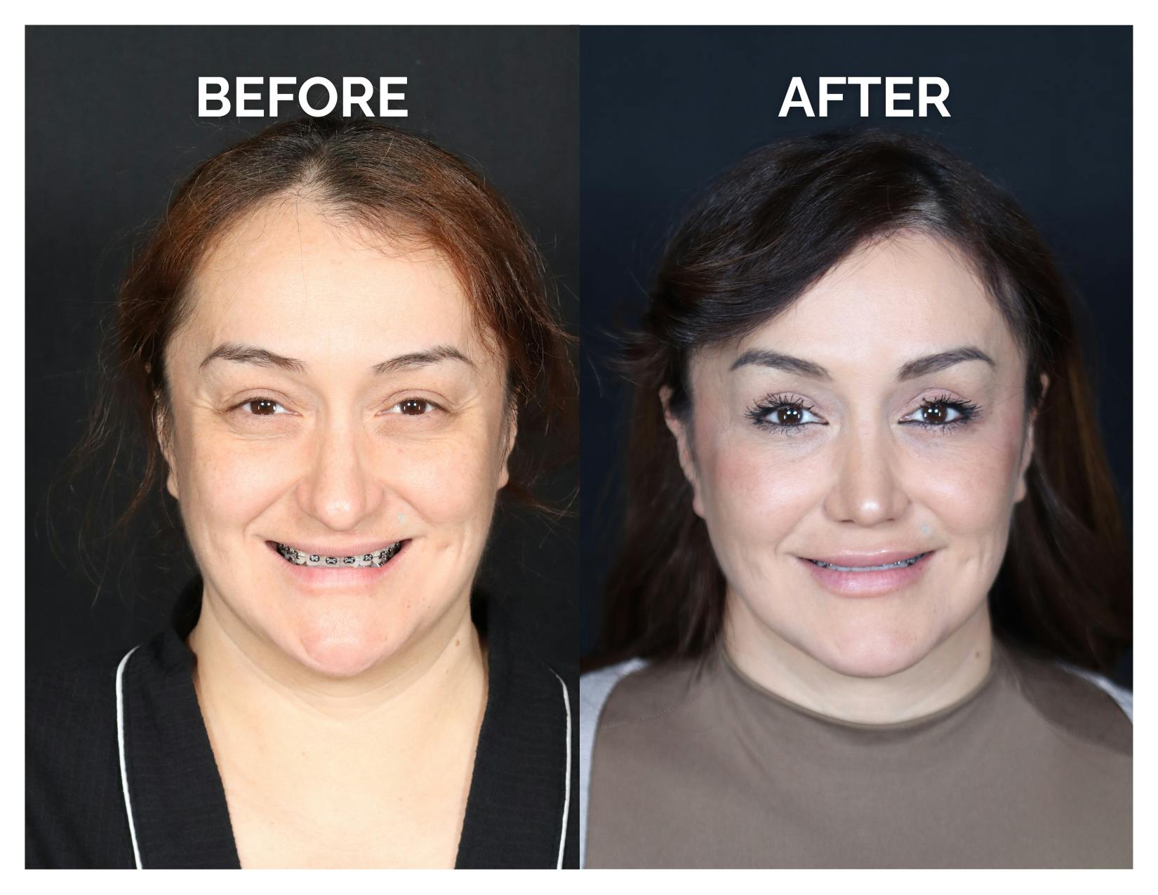 Rhinoplasty Before & After Gallery - Patient 223270 - Image 7