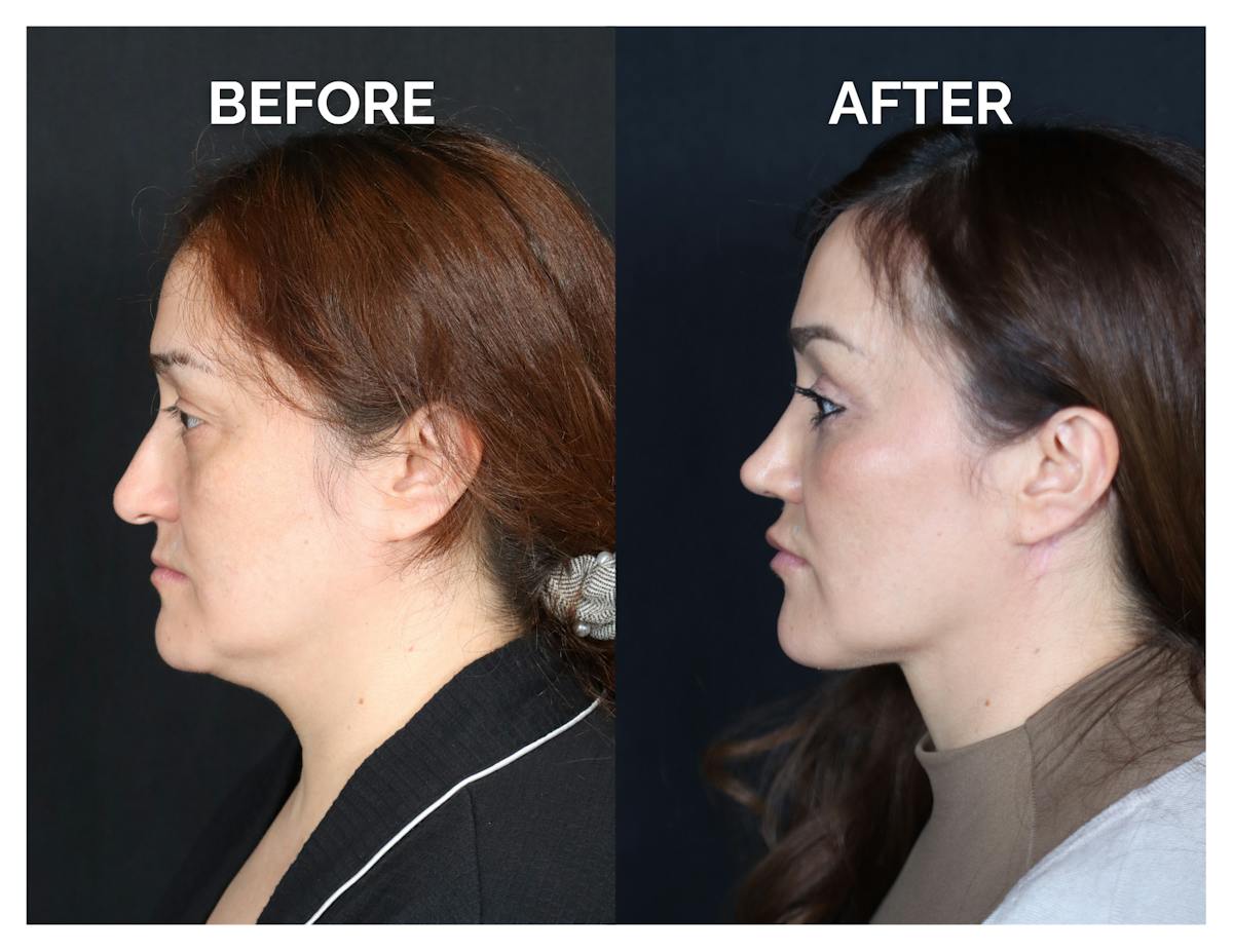 Rhinoplasty Before & After Gallery - Patient 223270 - Image 6