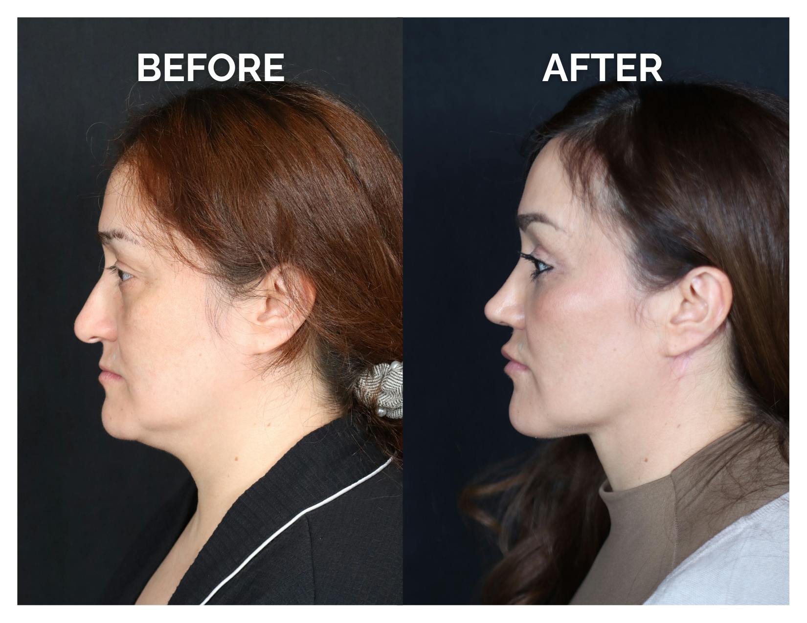 Rhinoplasty Before & After Gallery - Patient 223270 - Image 6