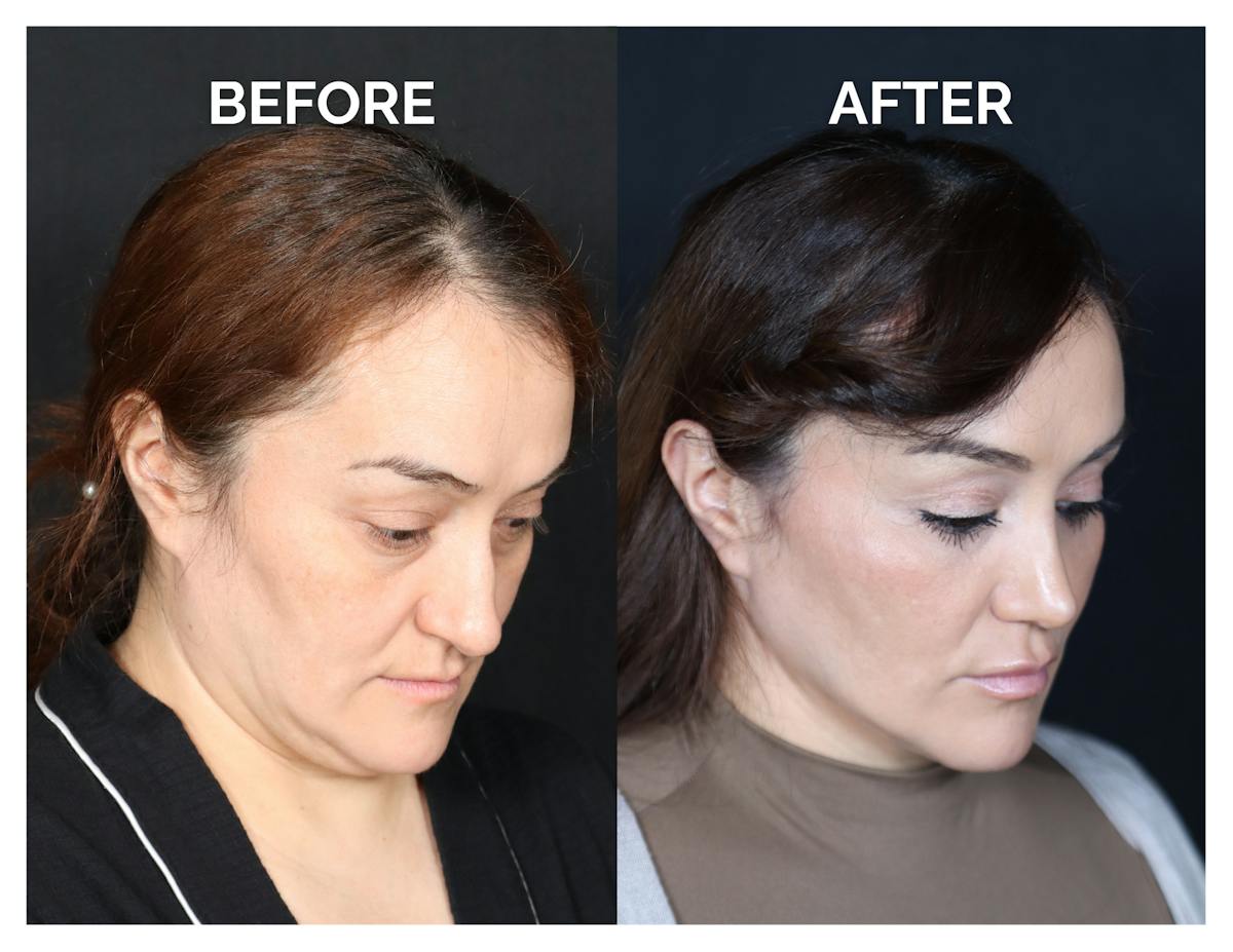 Rhinoplasty Before & After Gallery - Patient 223270 - Image 2