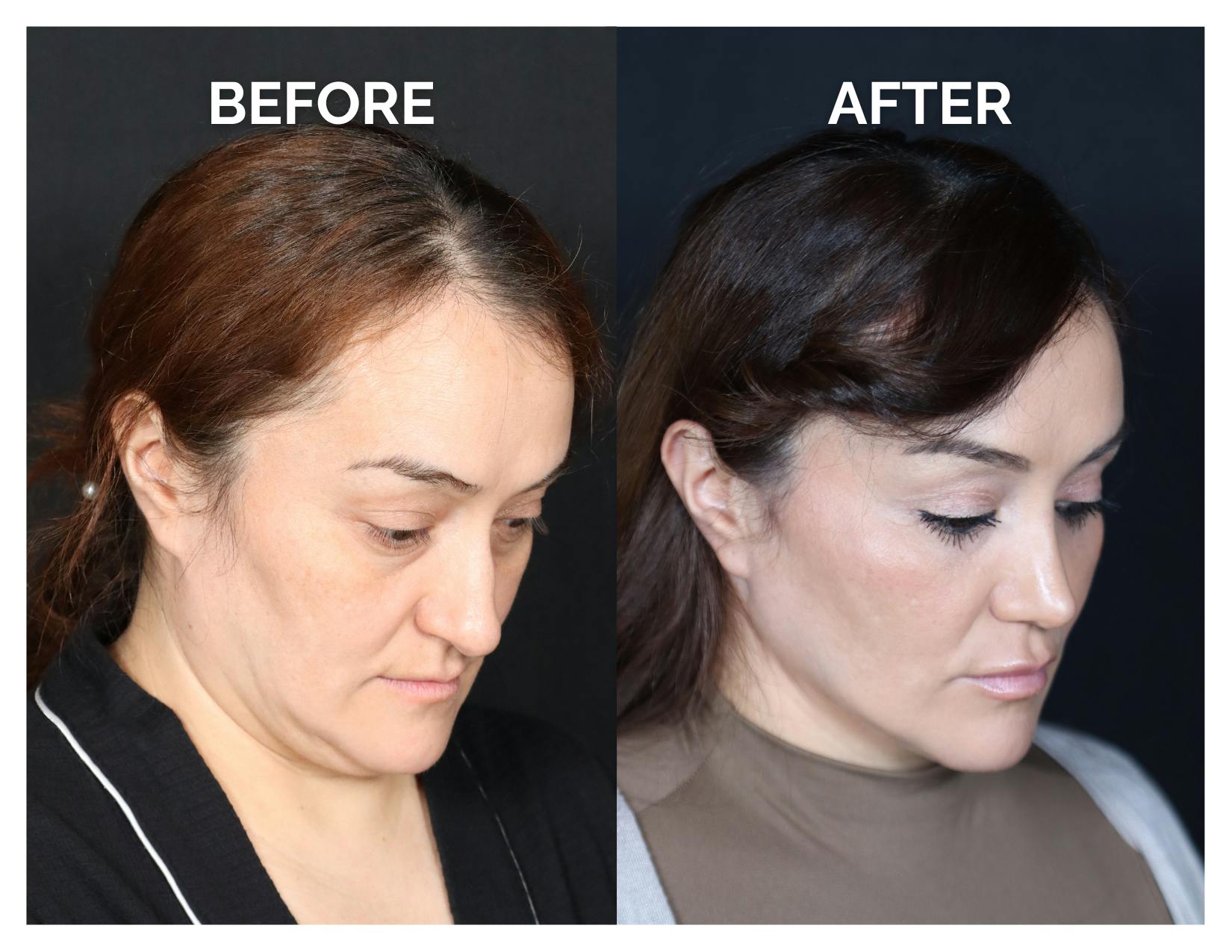 Rhinoplasty Before & After Gallery - Patient 223270 - Image 2