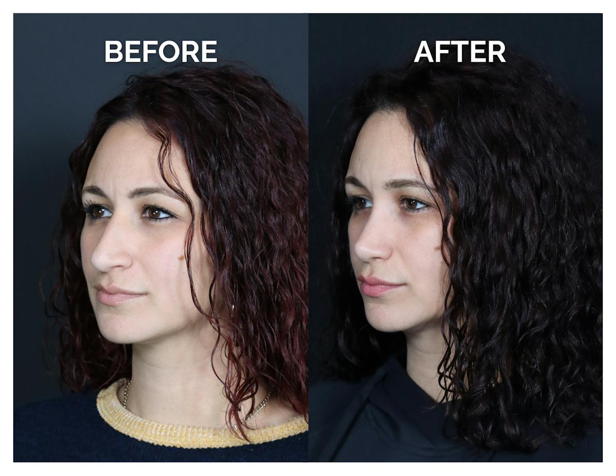 Rhinoplasty Before & After Gallery - Patient 417749 - Image 5