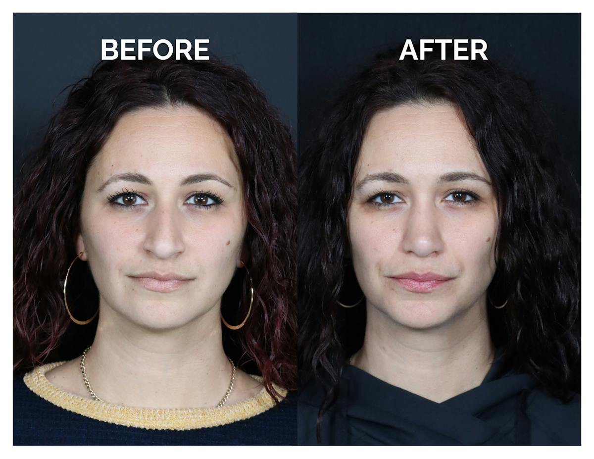 Rhinoplasty Before & After Gallery - Patient 417749 - Image 3