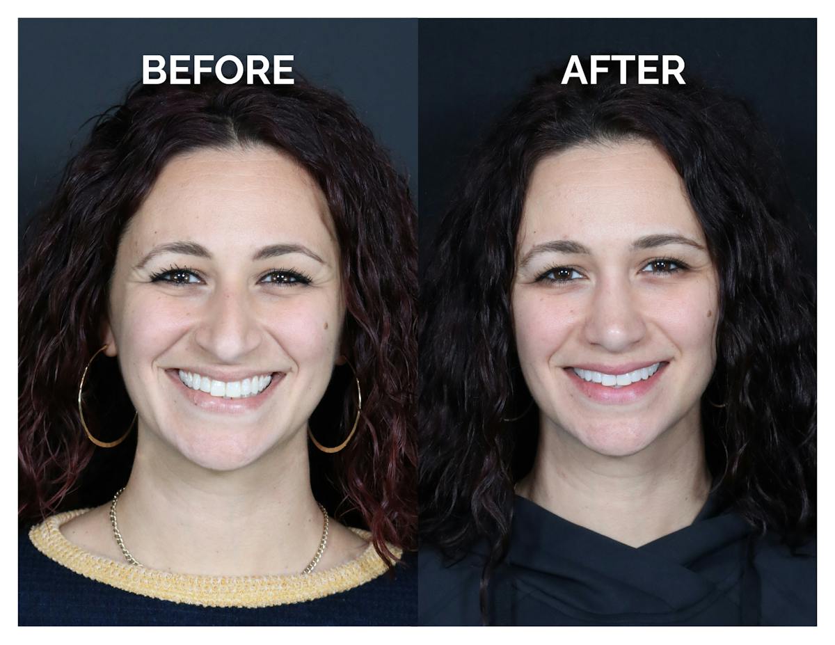 Rhinoplasty Before & After Gallery - Patient 417749 - Image 4