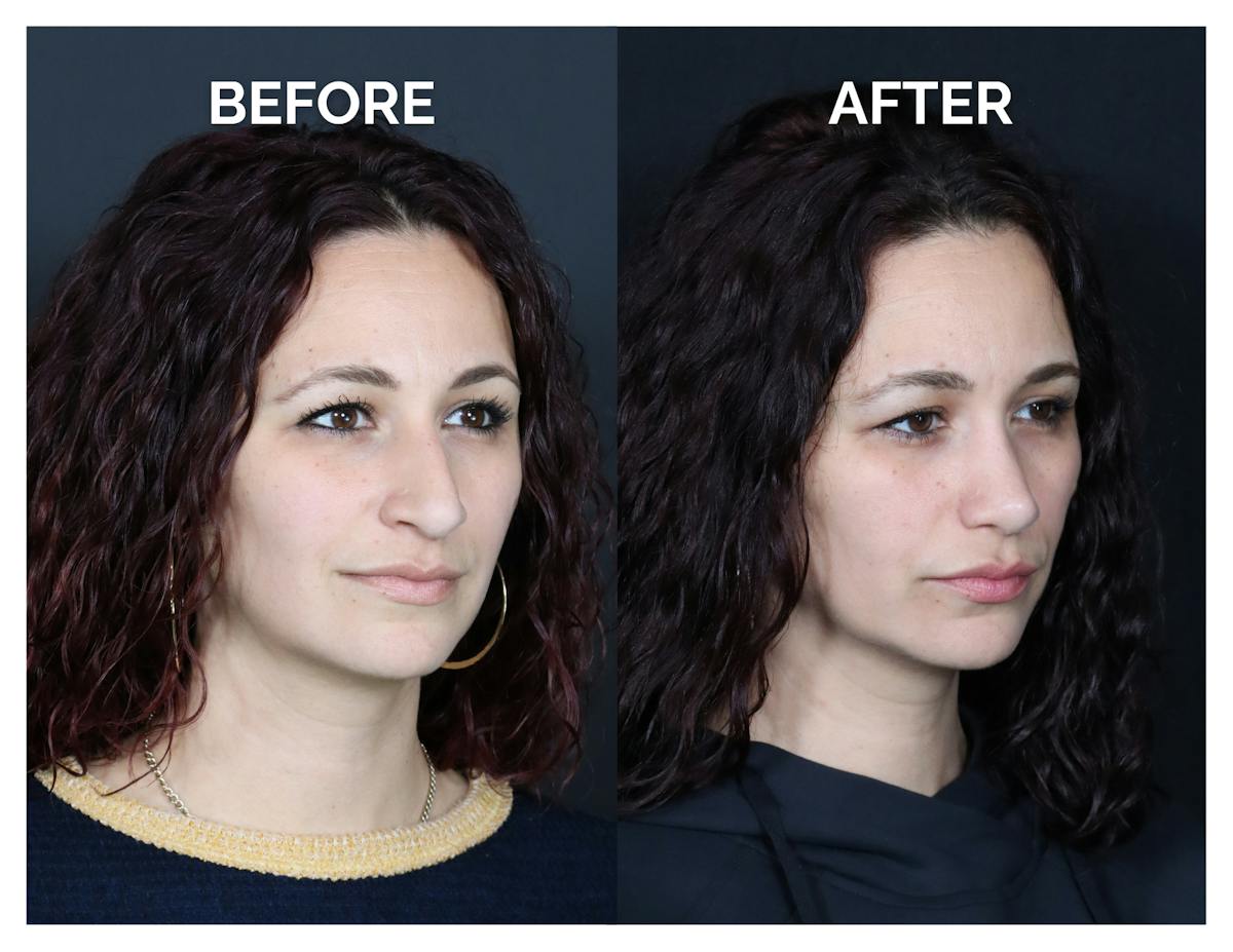 Rhinoplasty Before & After Gallery - Patient 417749 - Image 1