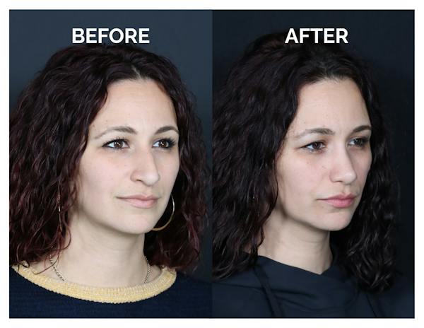 Rhinoplasty Before & After Gallery - Patient 417749 - Image 1