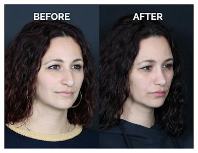 Rhinoplasty Before & After Gallery - Patient 417749 - Image 1