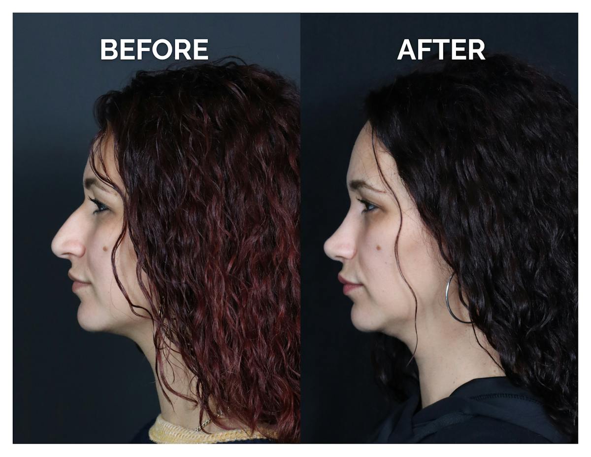 Rhinoplasty Before & After Gallery - Patient 417749 - Image 6