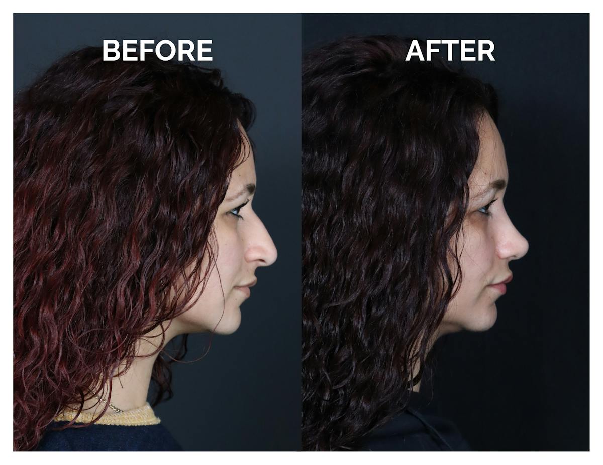 Rhinoplasty Before & After Gallery - Patient 417749 - Image 2