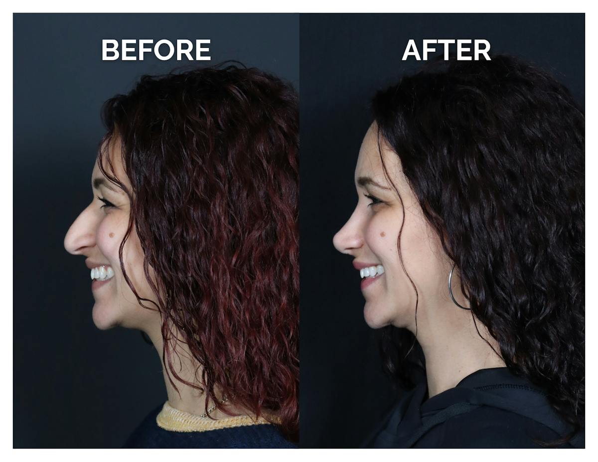 Rhinoplasty Before & After Gallery - Patient 417749 - Image 7