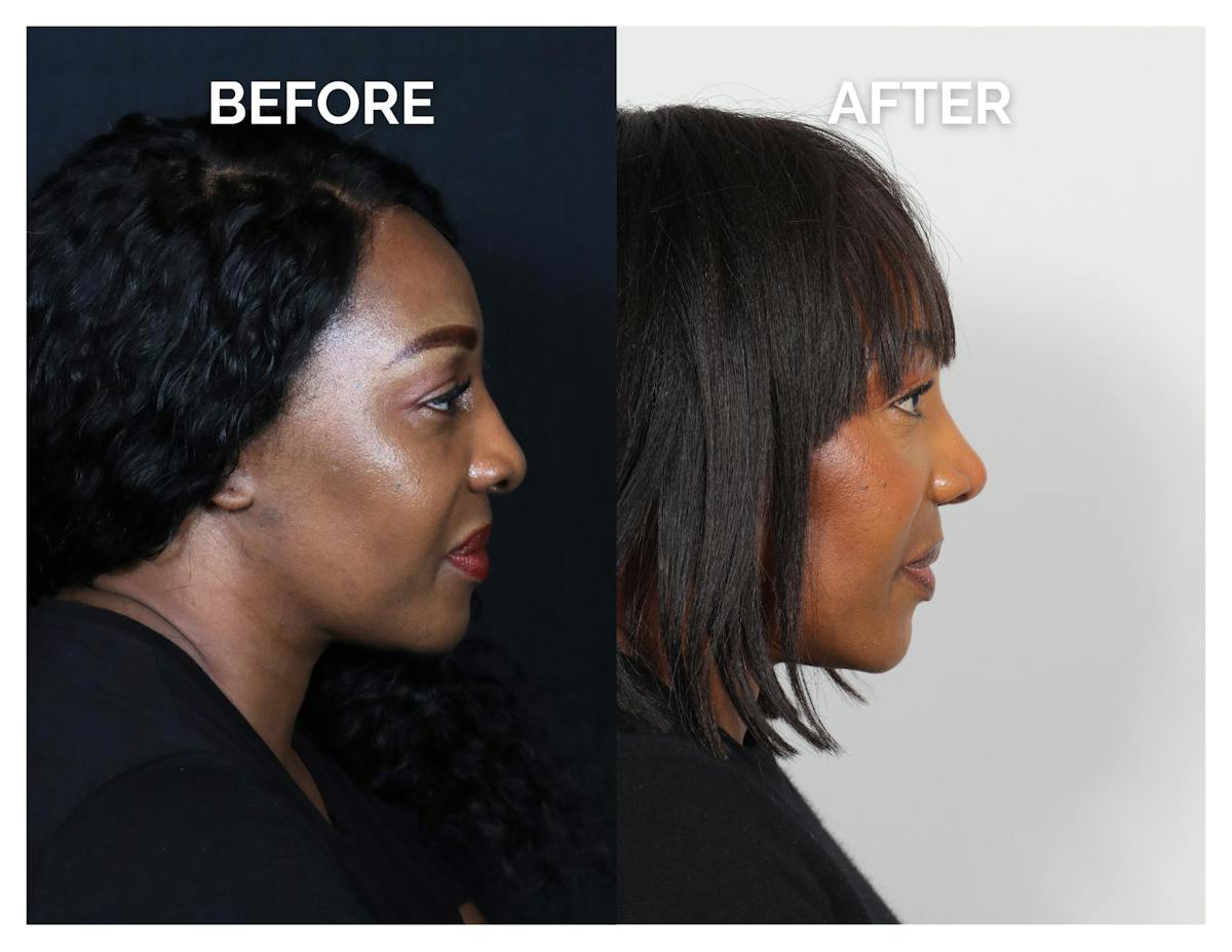 Rhinoplasty Before & After Gallery - Patient 172825 - Image 2
