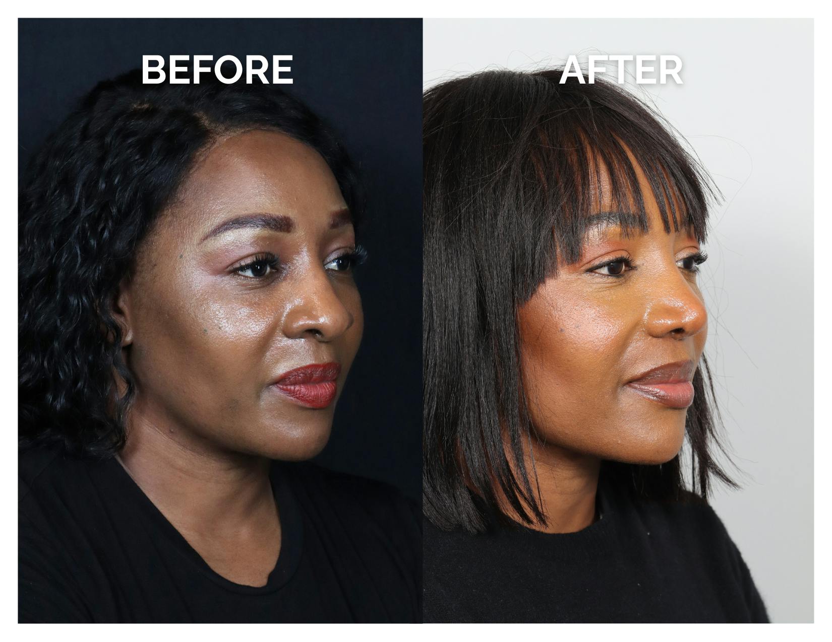 Rhinoplasty Before & After Gallery - Patient 172825 - Image 1
