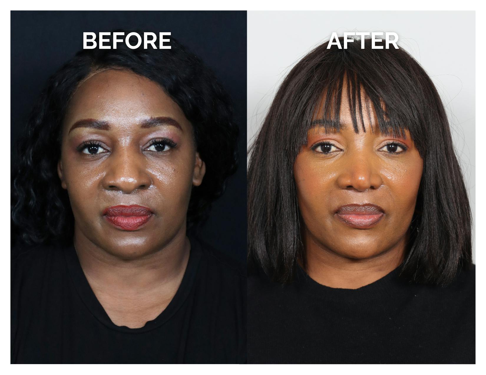 Rhinoplasty Before & After Gallery - Patient 172825 - Image 3