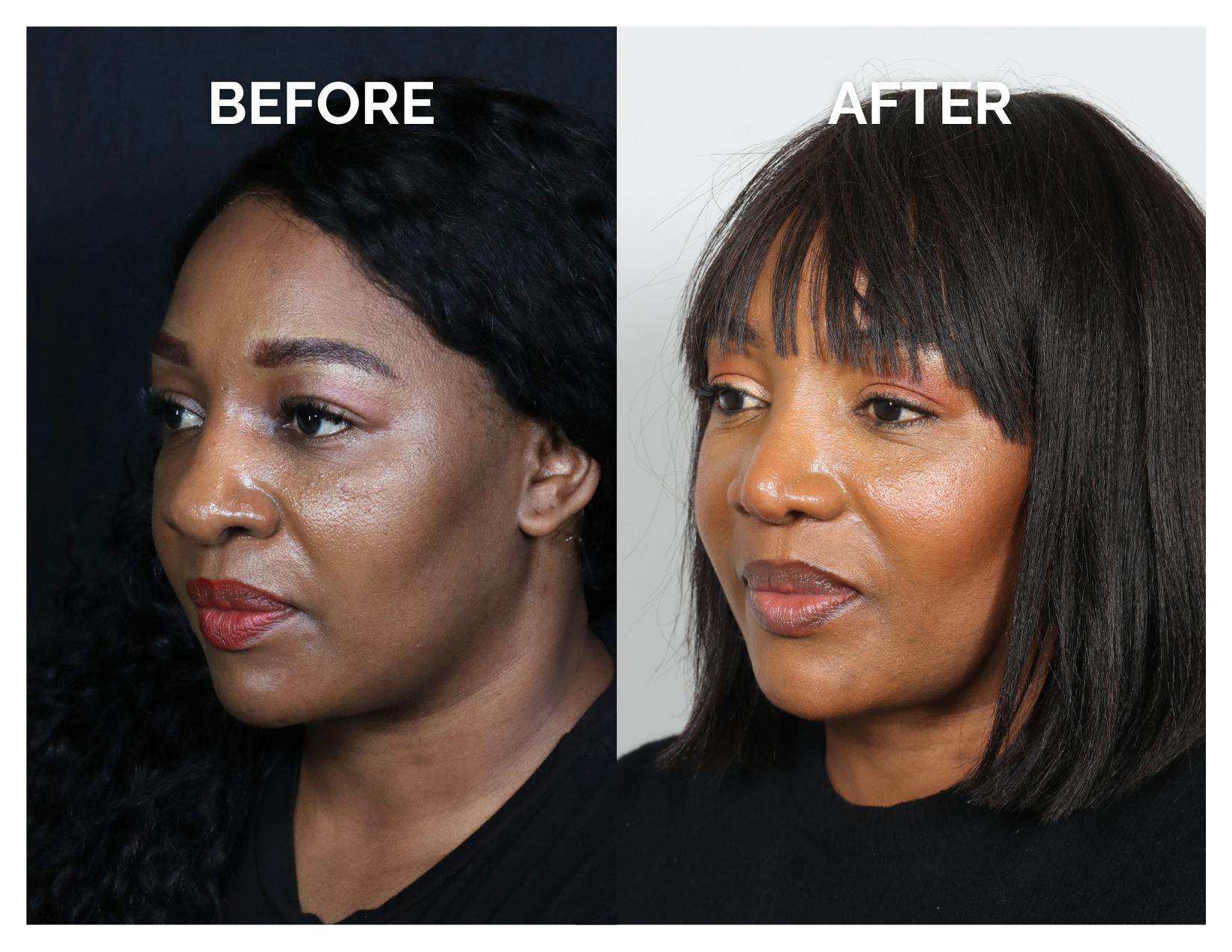 Rhinoplasty Before & After Gallery - Patient 172825 - Image 4