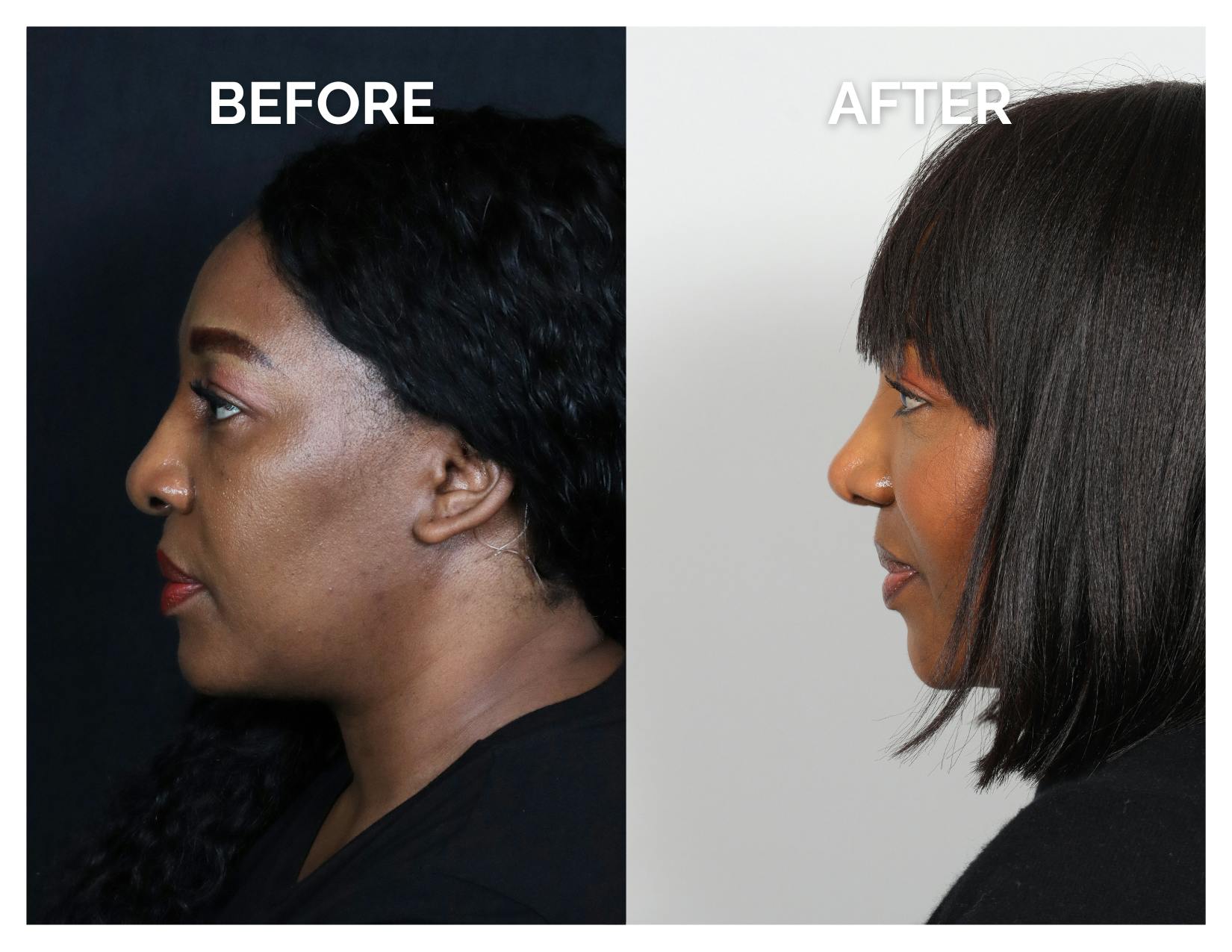 Rhinoplasty Before & After Gallery - Patient 172825 - Image 5