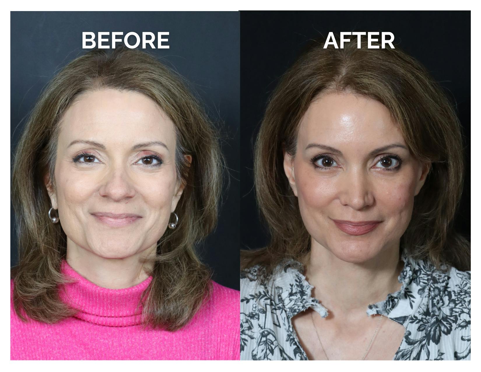 Rhinoplasty Before & After Gallery - Patient 360365 - Image 2
