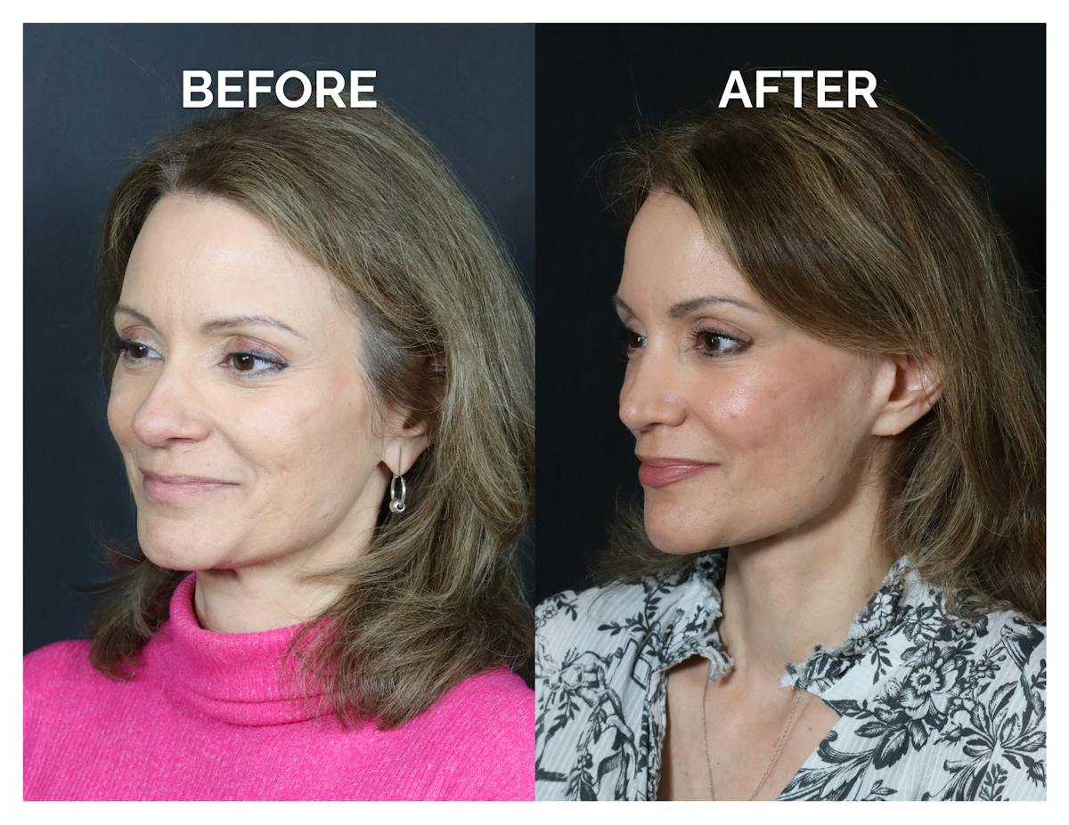 Rhinoplasty Before & After Gallery - Patient 360365 - Image 3