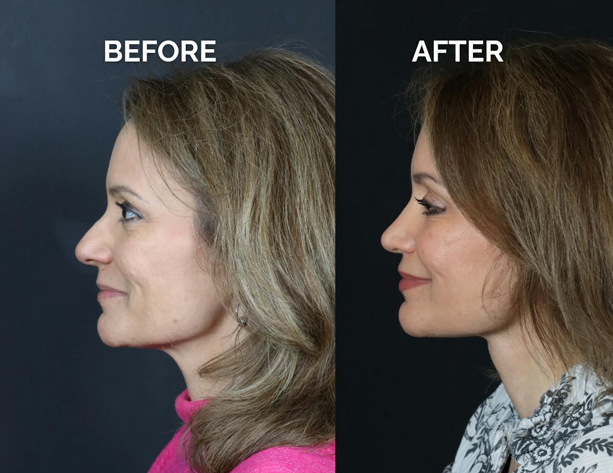 Rhinoplasty Before & After Gallery - Patient 360365 - Image 4