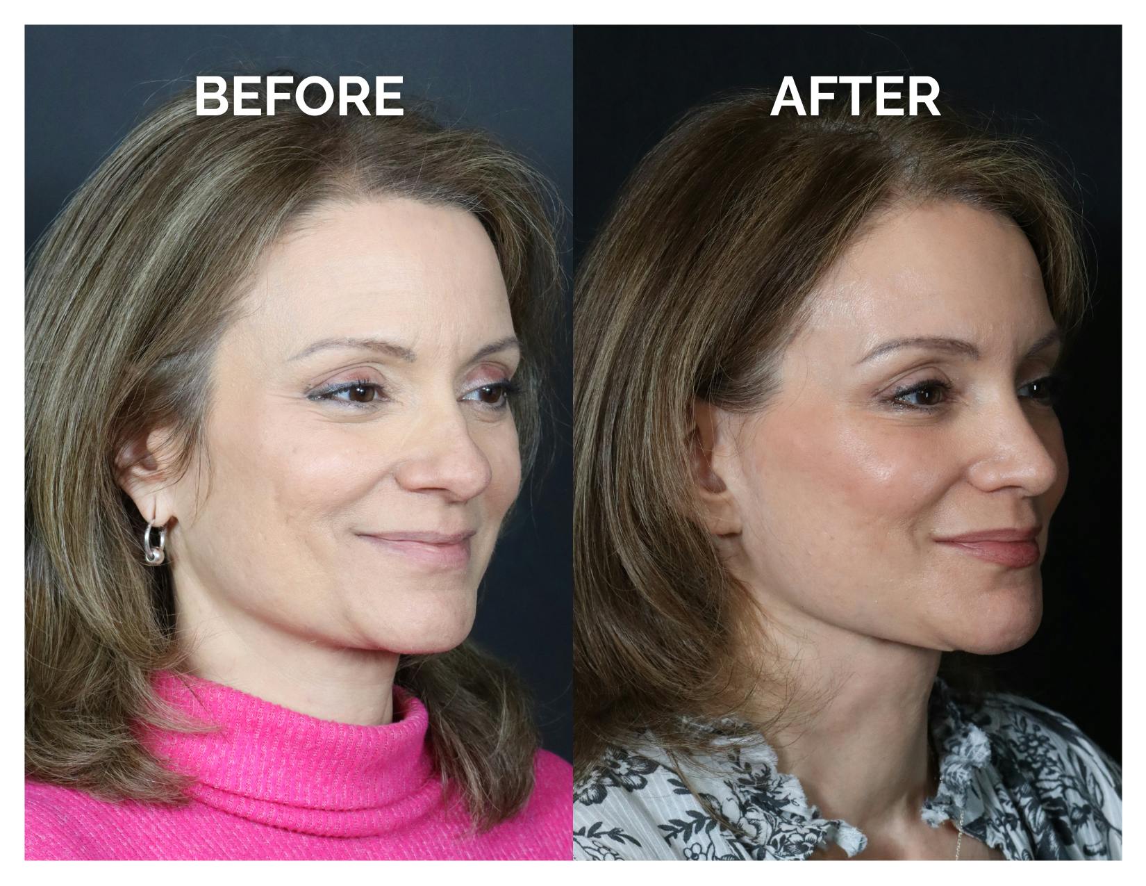 Rhinoplasty Before & After Gallery - Patient 360365 - Image 1