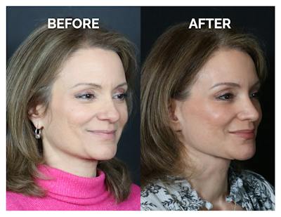 Rhinoplasty Before & After Gallery - Patient 360365 - Image 1