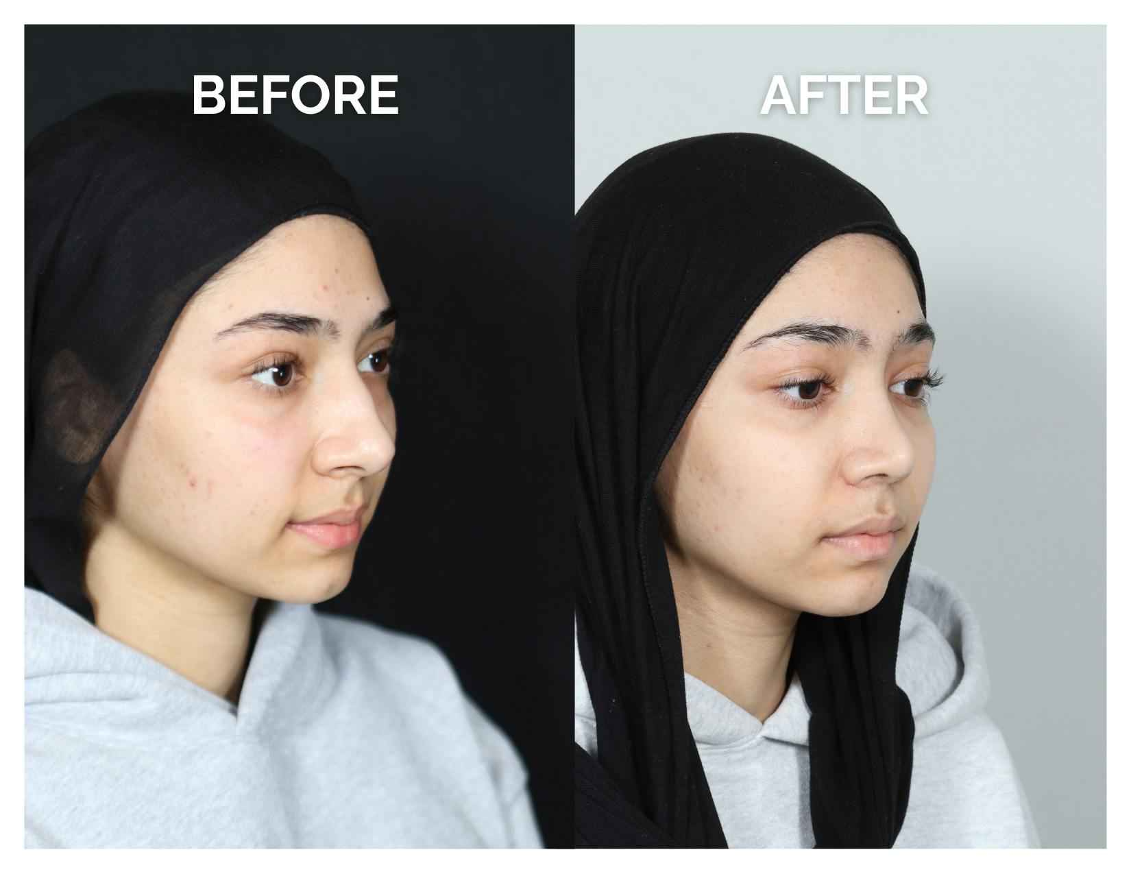 Rhinoplasty Before & After Gallery - Patient 415513 - Image 3