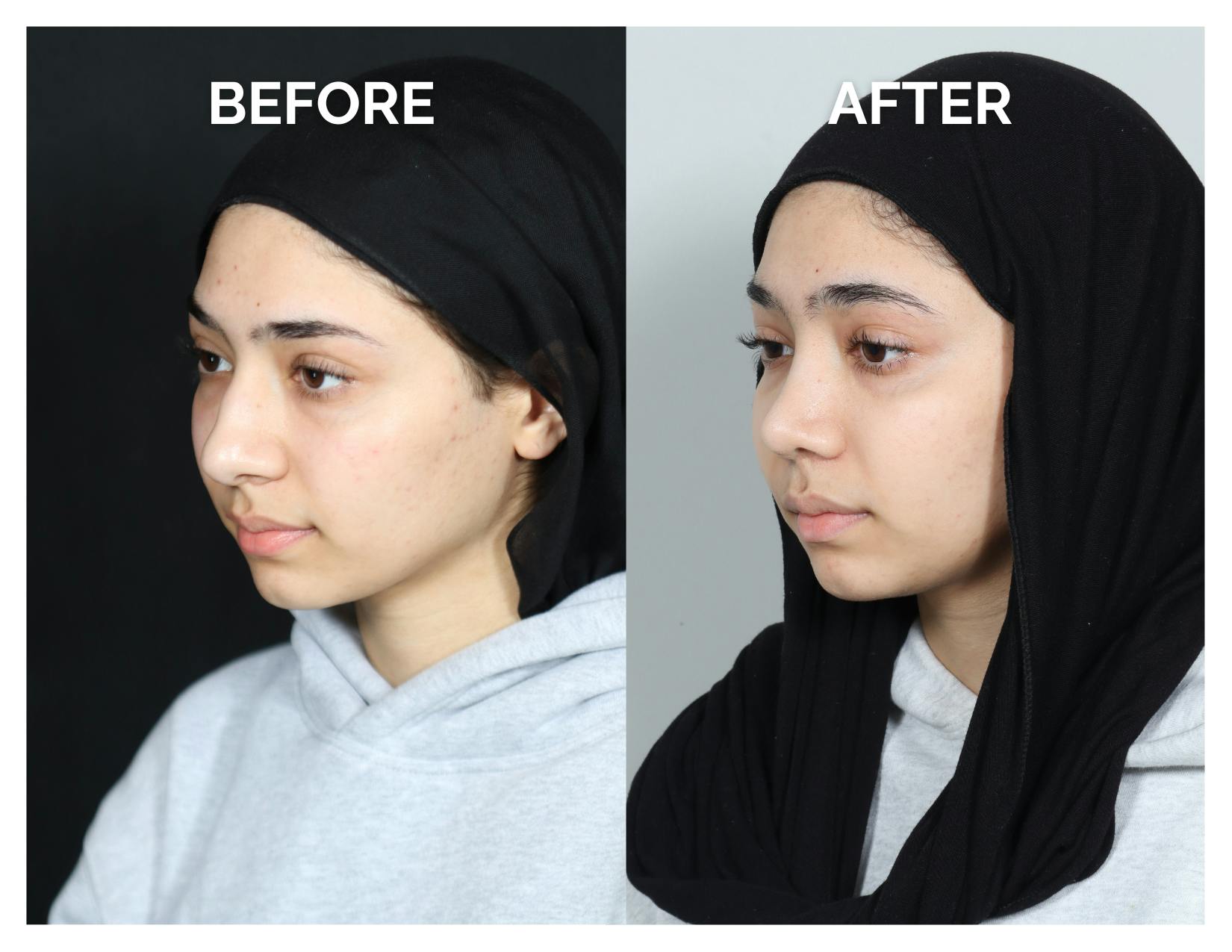 Rhinoplasty Before & After Gallery - Patient 415513 - Image 4