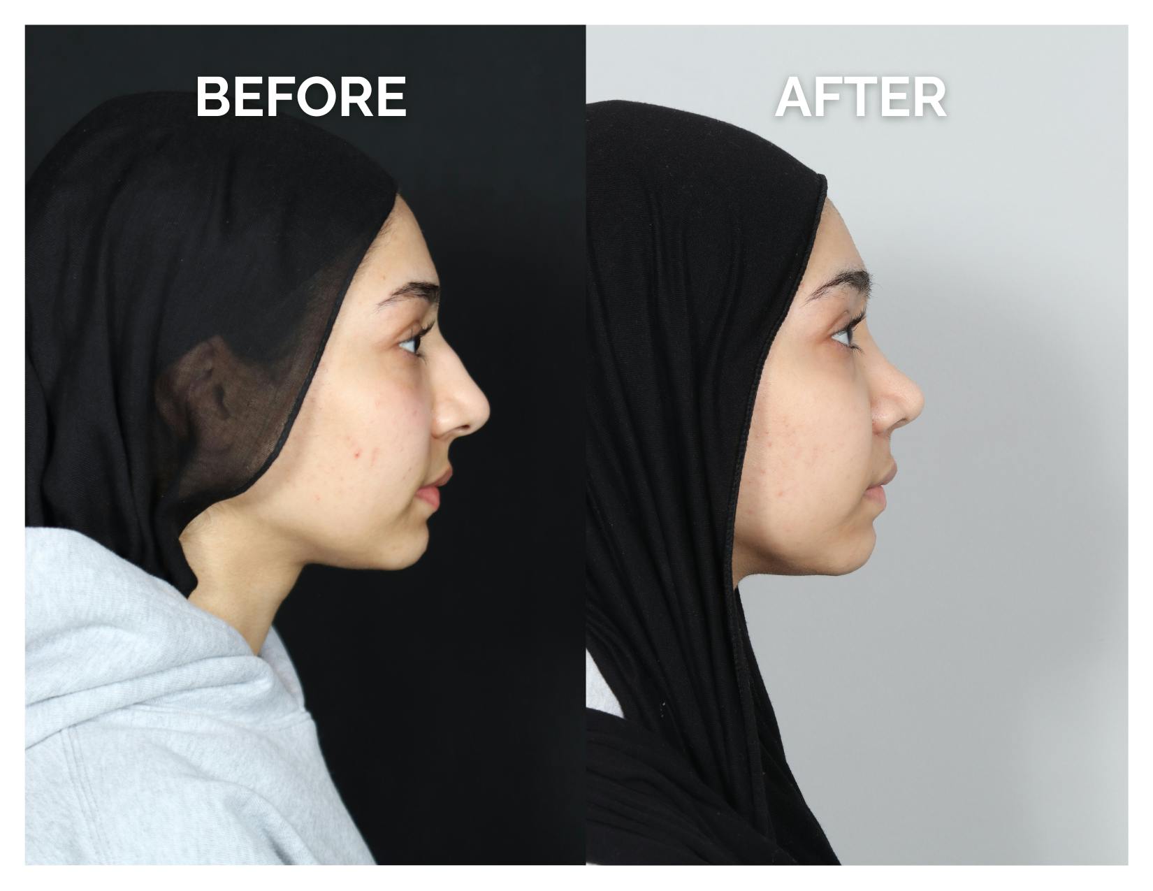 Rhinoplasty Before & After Gallery - Patient 415513 - Image 2