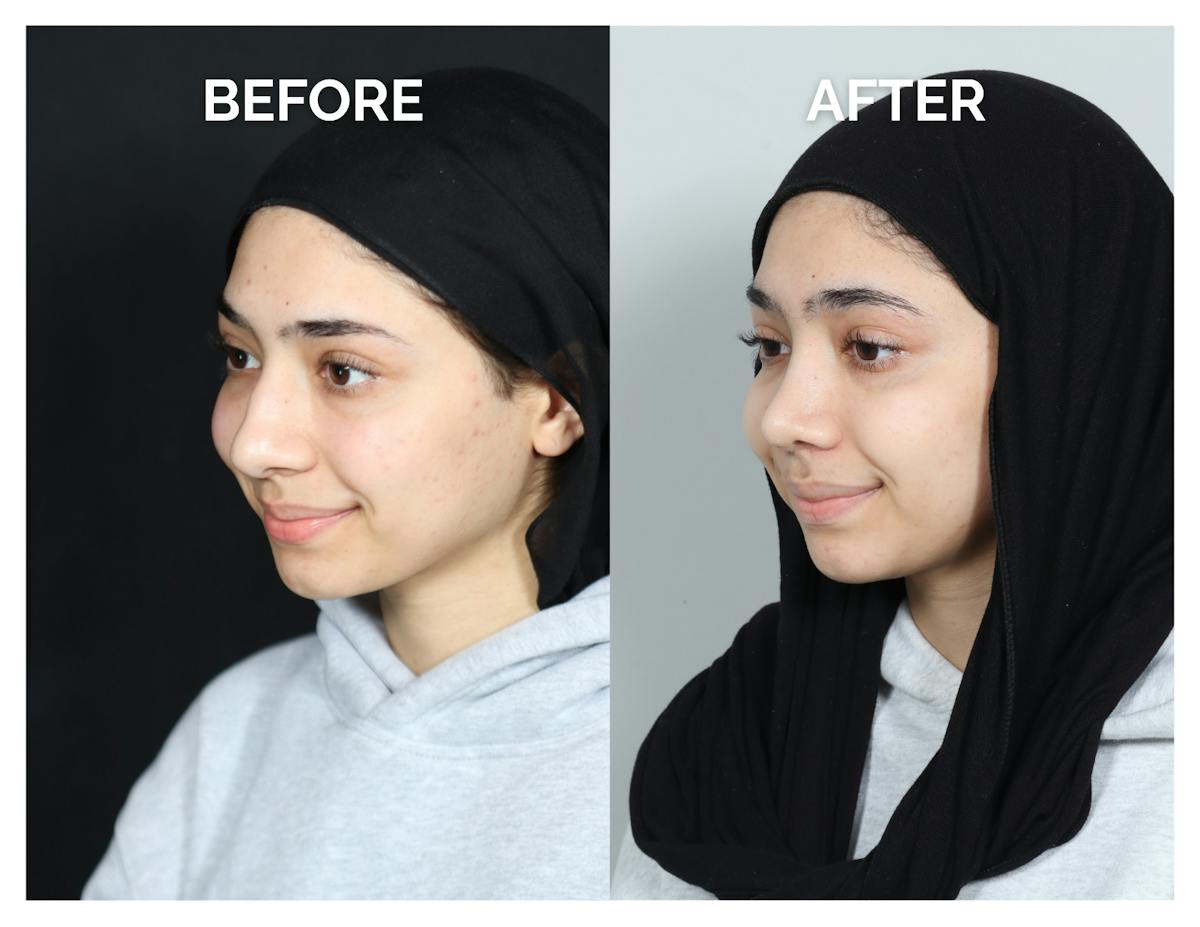 Rhinoplasty Before & After Gallery - Patient 415513 - Image 5