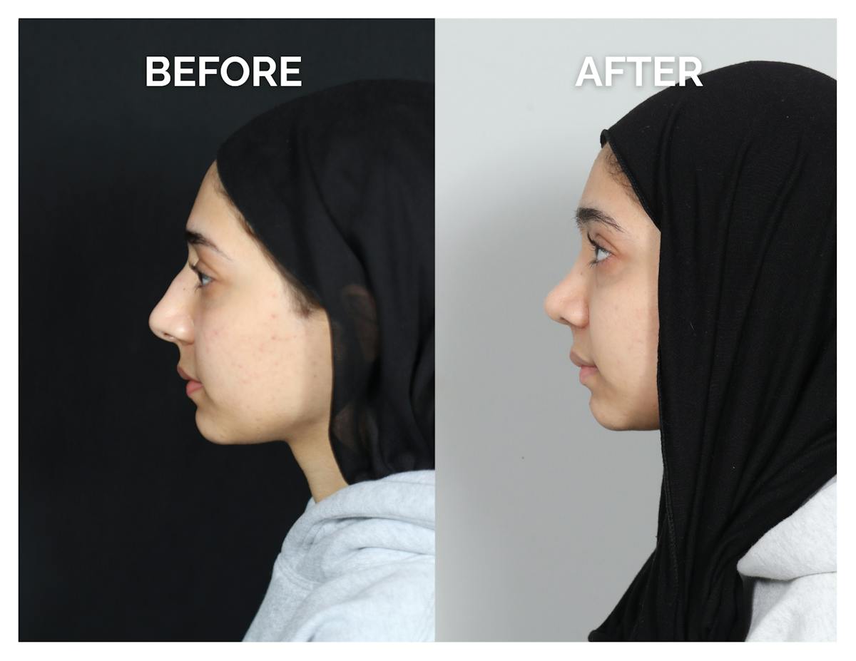 Rhinoplasty Before & After Gallery - Patient 415513 - Image 6