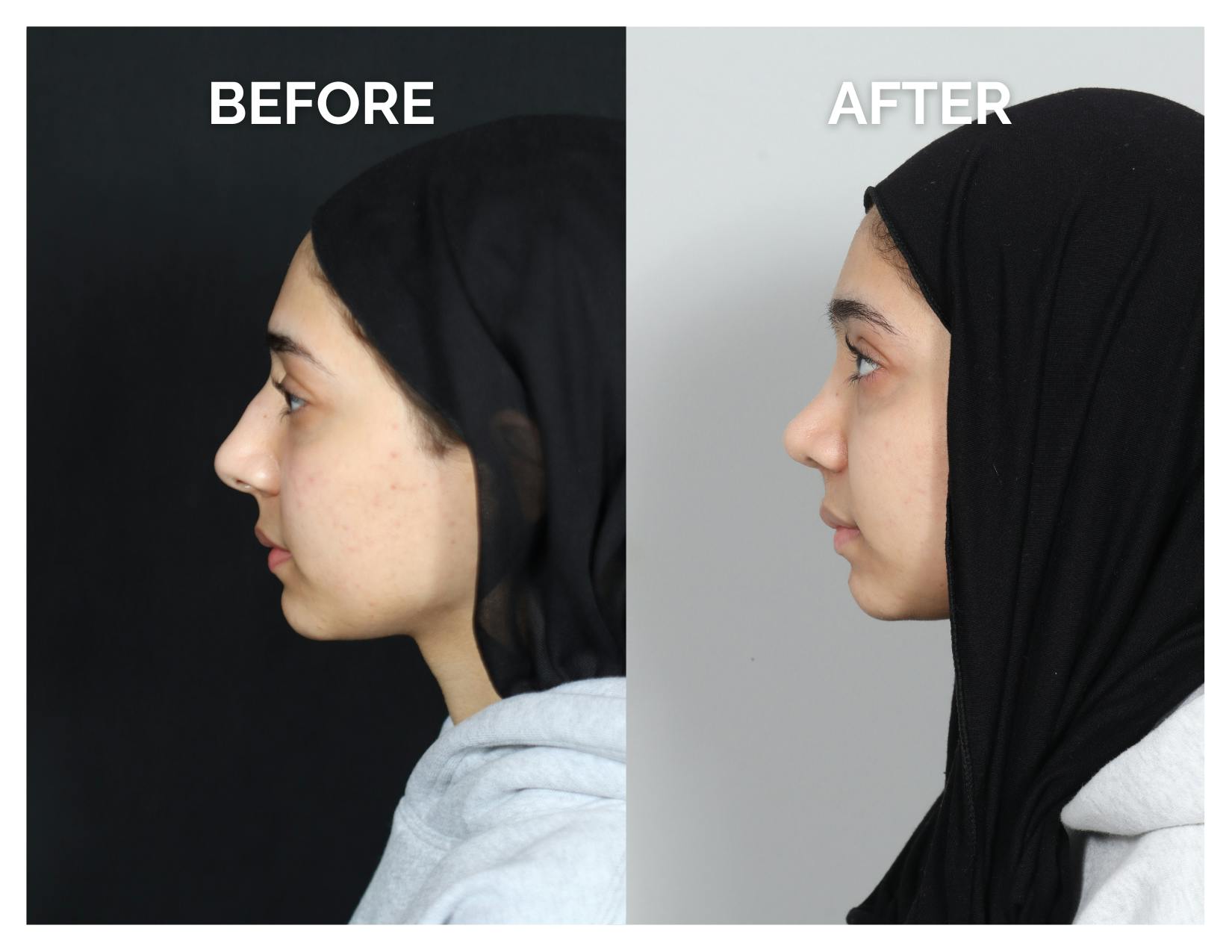 Rhinoplasty Before & After Gallery - Patient 415513 - Image 6