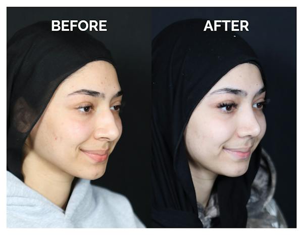Rhinoplasty Before & After Gallery - Patient 415513 - Image 1