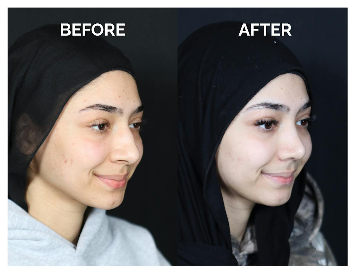 Rhinoplasty Before & After Gallery - Patient 415513 - Image 1