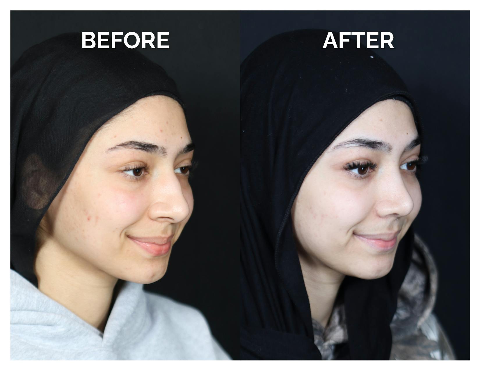 Rhinoplasty Before & After Gallery - Patient 415513 - Image 1
