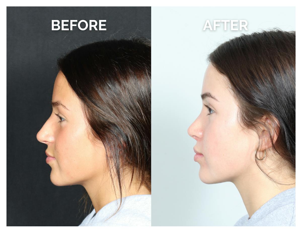 Rhinoplasty Before & After Gallery - Patient 302997 - Image 5