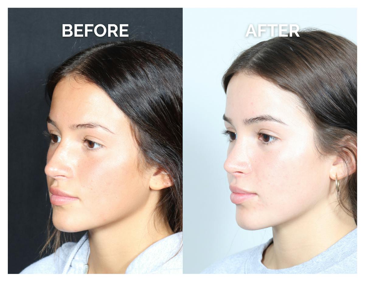 Rhinoplasty Before & After Gallery - Patient 302997 - Image 4