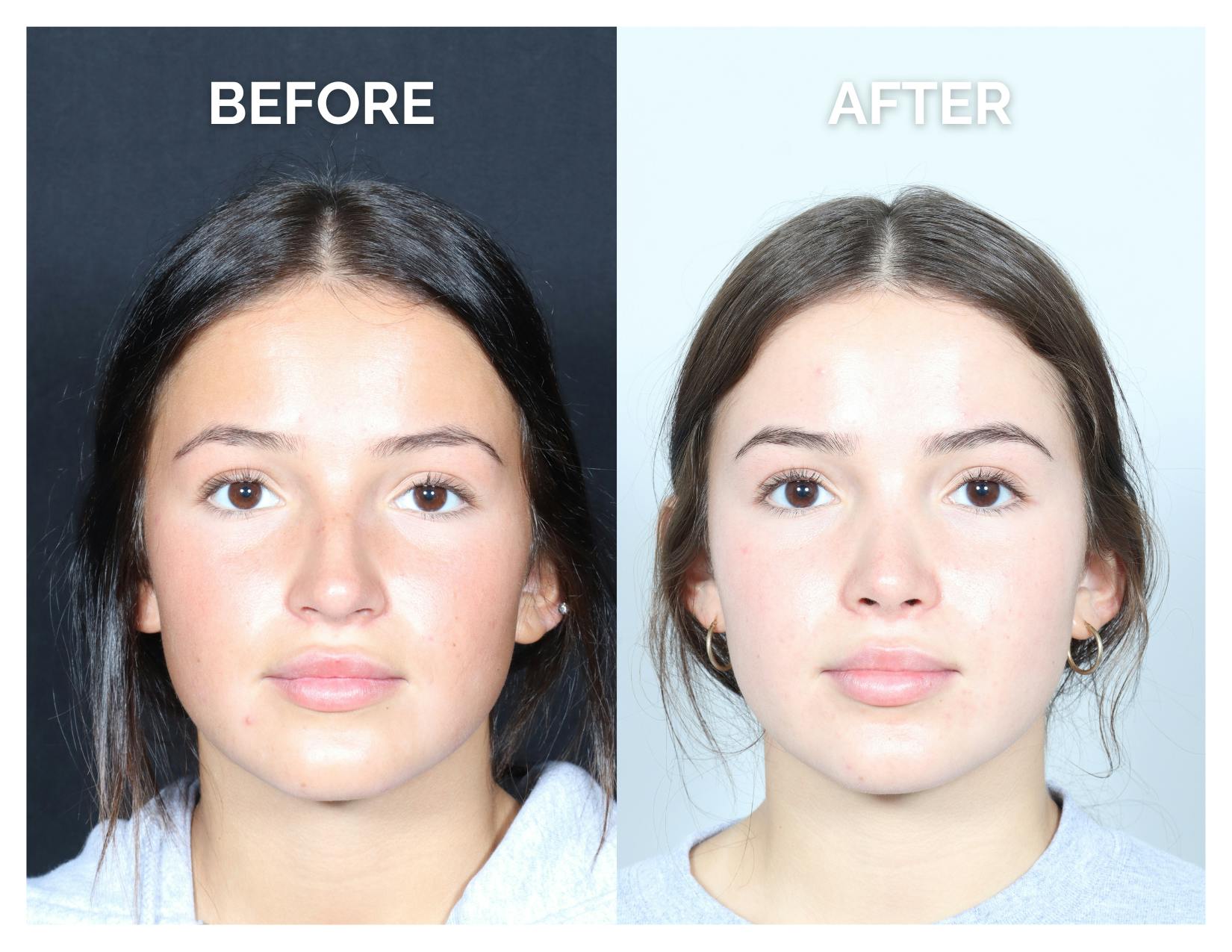 Rhinoplasty Before & After Gallery - Patient 302997 - Image 3