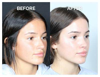 Rhinoplasty Before & After Gallery - Patient 302997 - Image 1