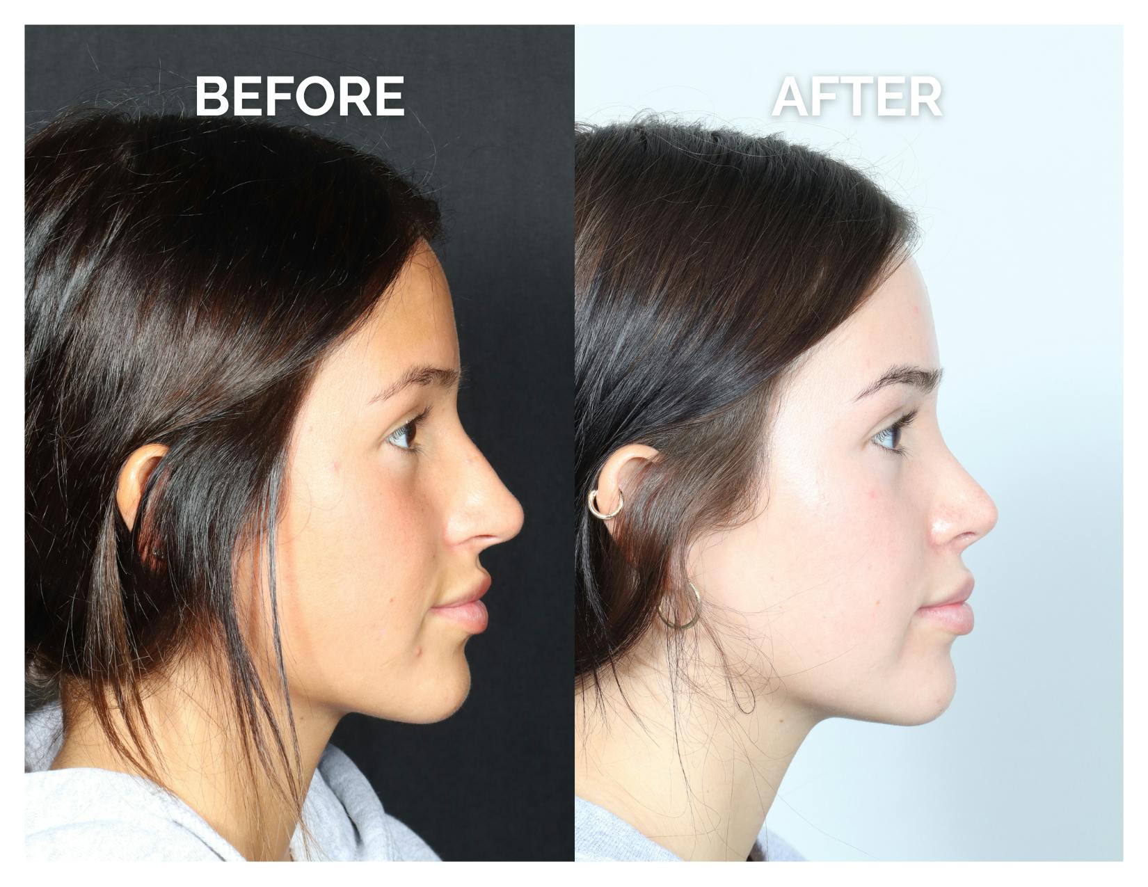 Rhinoplasty Before & After Gallery - Patient 302997 - Image 2