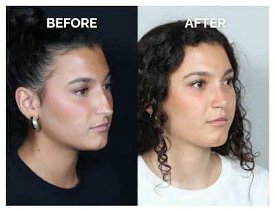 Rhinoplasty Before & After Gallery - Patient 969451 - Image 1