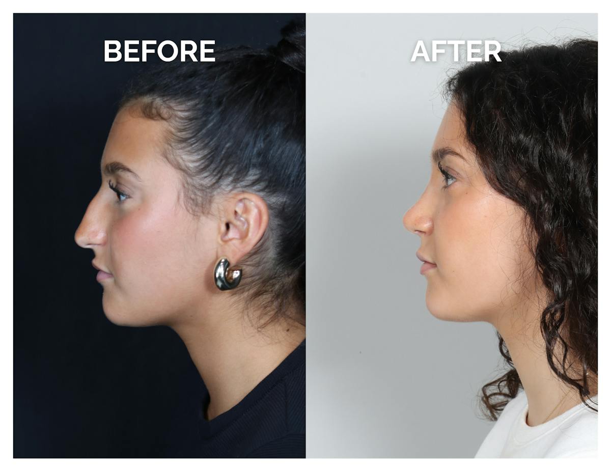 Rhinoplasty Before & After Gallery - Patient 969451 - Image 5