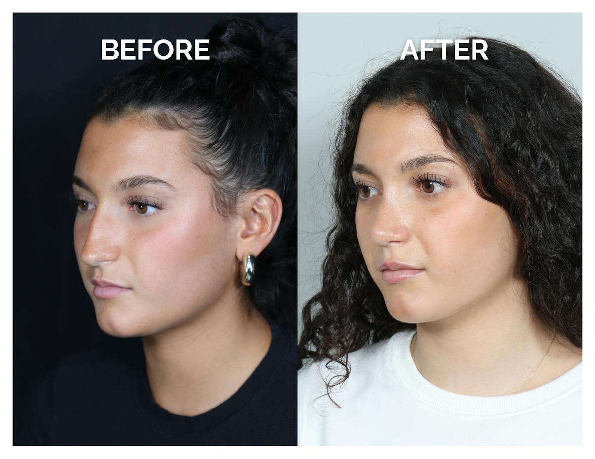 Rhinoplasty Before & After Gallery - Patient 969451 - Image 4