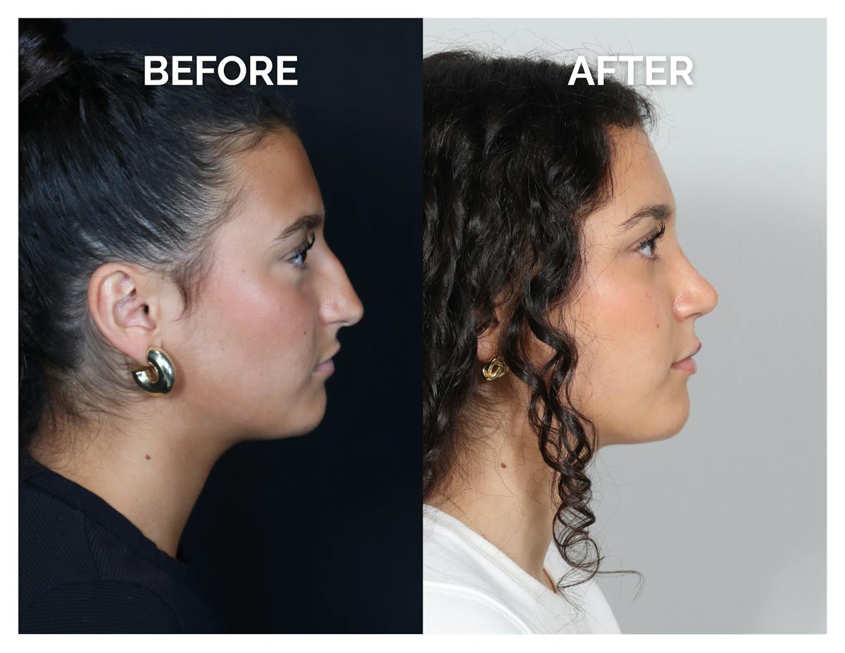Rhinoplasty Before & After Gallery - Patient 969451 - Image 2