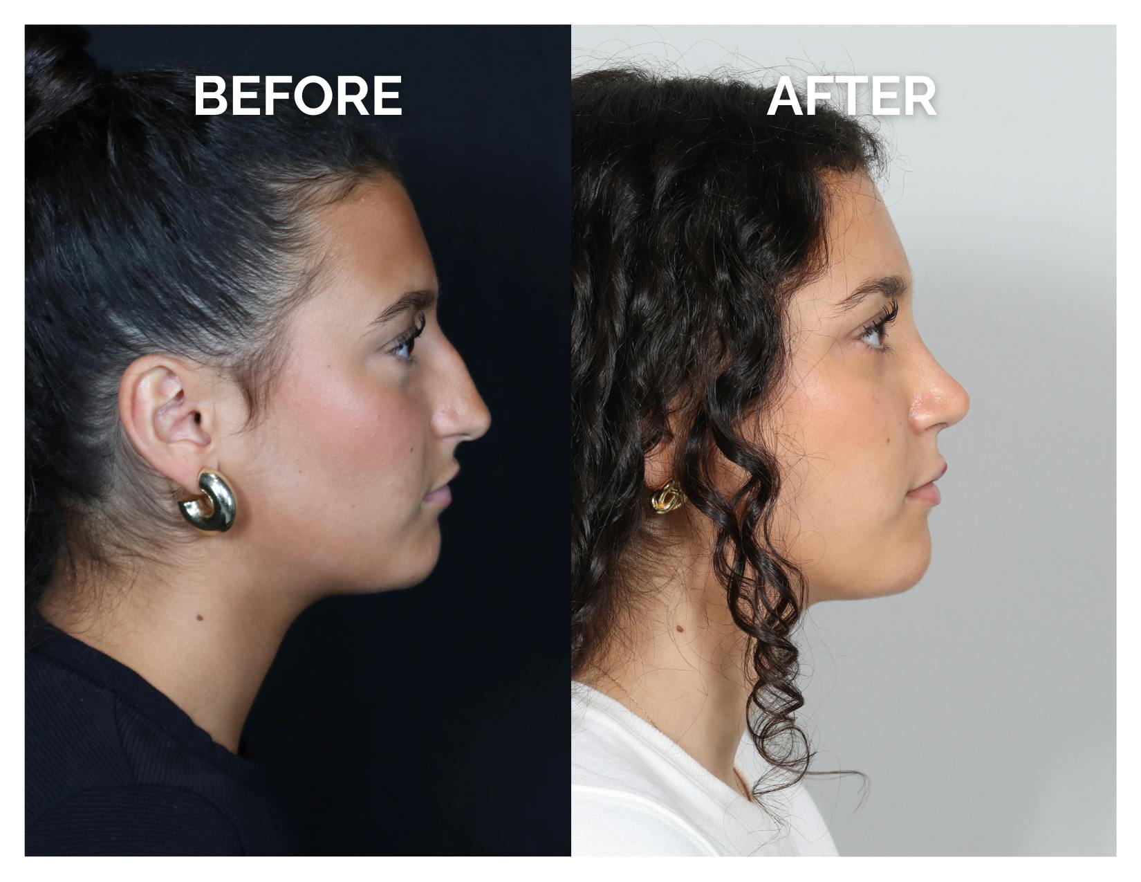 Rhinoplasty Before & After Gallery - Patient 969451 - Image 2